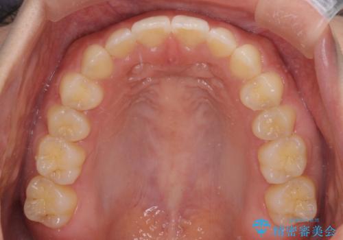 気になる隙間の再矯正 前歯をインビザライン・ライトで改善の治療後