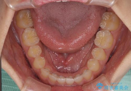 気になる隙間の再矯正 前歯をインビザライン・ライトで改善の治療後