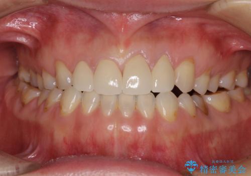 欠けてガタガタの前歯 オールセラミッククラウンによる補綴治療の治療後
