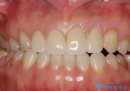 欠けてガタガタの前歯 オールセラミッククラウンによる補綴治療の治療後