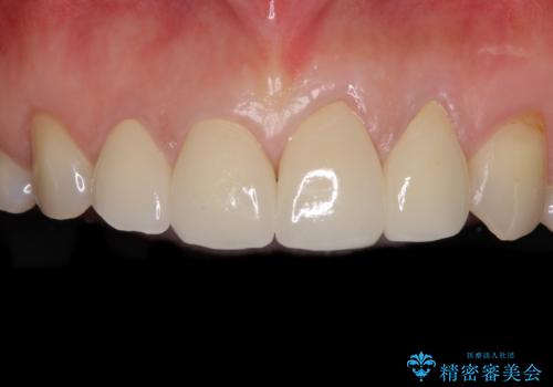 欠けてガタガタの前歯 オールセラミッククラウンによる補綴治療の症例 治療後