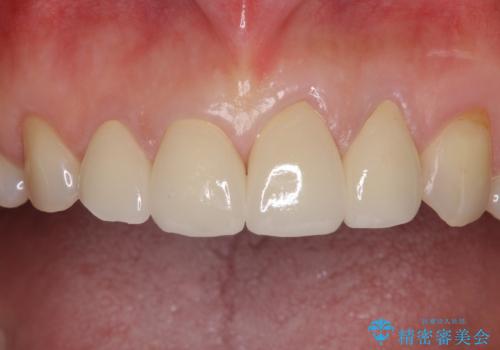 欠けてガタガタの前歯 オールセラミッククラウンによる補綴治療の治療後