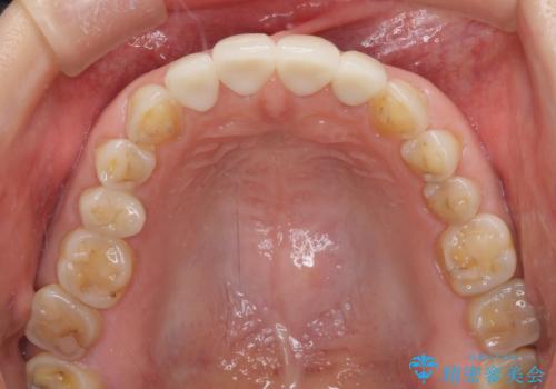 欠けてガタガタの前歯 オールセラミッククラウンによる補綴治療の治療後