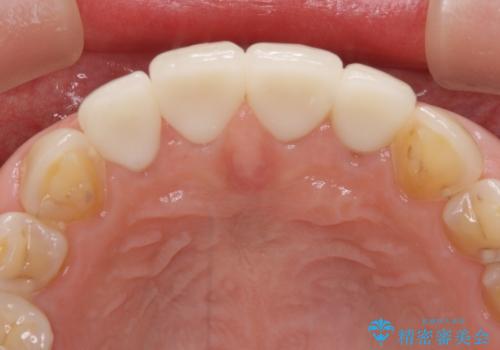 欠けてガタガタの前歯 オールセラミッククラウンによる補綴治療の治療後