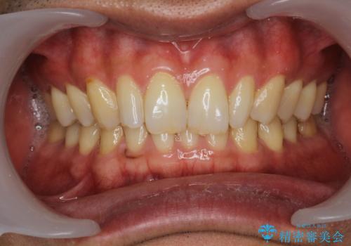 20代男性のオフィスホワイトニングの症例 治療前