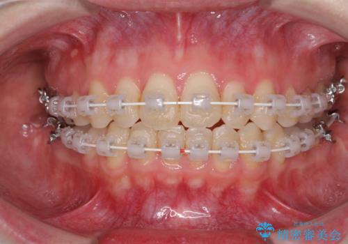 前歯のデコボコを改善　目立たないワイヤー矯正の治療中