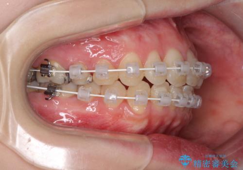 前歯のデコボコを改善 目立たないワイヤー矯正の治療中