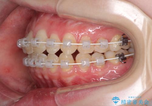 前歯のデコボコを改善 目立たないワイヤー矯正の治療中