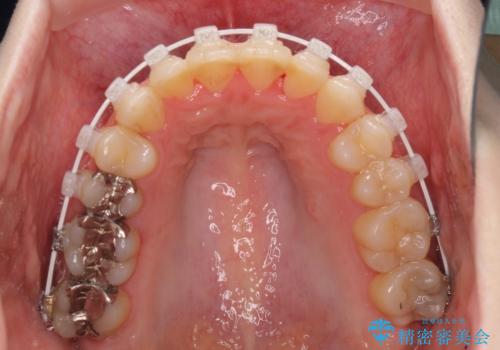 前歯のデコボコを改善　目立たないワイヤー矯正の治療中