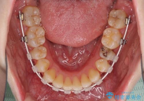 前歯のデコボコを改善 目立たないワイヤー矯正の治療中