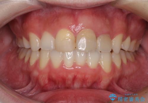 抜歯矯正の後戻り インビザラインによるオープンバイトの再矯正の症例 治療後