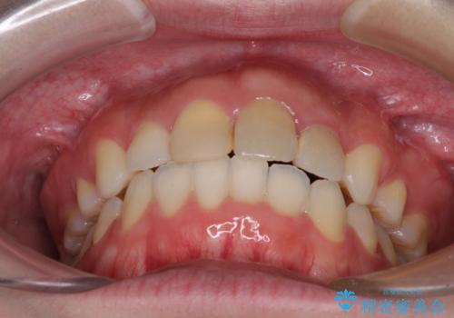 抜歯矯正の後戻り インビザラインによるオープンバイトの再矯正の治療後