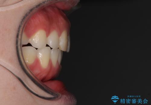 抜歯矯正の後戻り インビザラインによるオープンバイトの再矯正の治療後