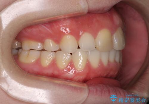 抜歯矯正の後戻り インビザラインによるオープンバイトの再矯正の治療後