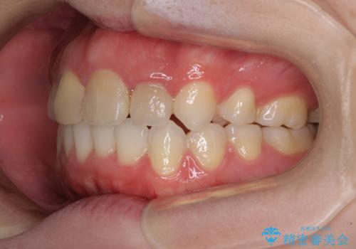 抜歯矯正の後戻り インビザラインによるオープンバイトの再矯正の治療後