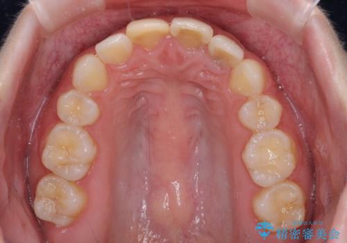 抜歯矯正の後戻り インビザラインによるオープンバイトの再矯正の治療後