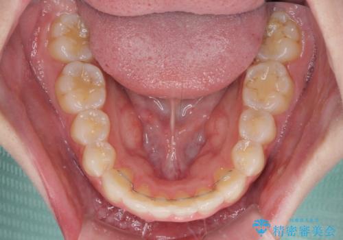 抜歯矯正の後戻り インビザラインによるオープンバイトの再矯正の治療後
