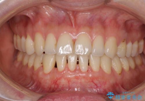 下顎前歯の歯肉退縮　歯肉移植による根面被覆の治療後