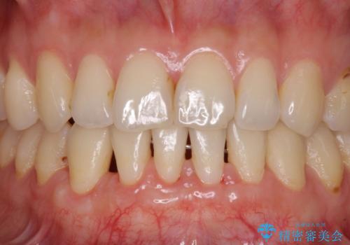 下顎前歯の歯肉退縮 歯肉移植による根面被覆の治療後