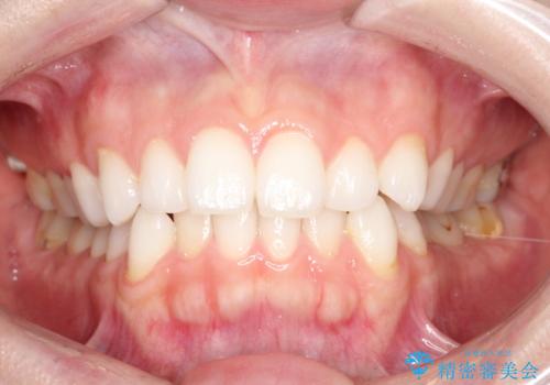 前歯のがたつきをインビザラインで目立たず矯正治療の治療前