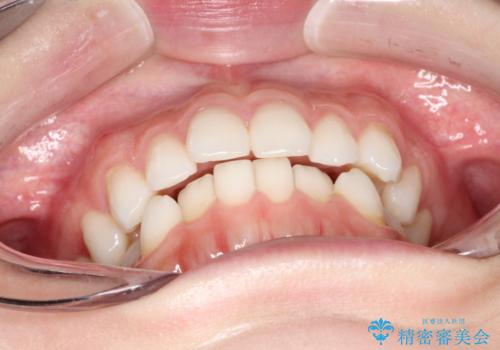 前歯のがたつきをインビザラインで目立たず矯正治療の治療前