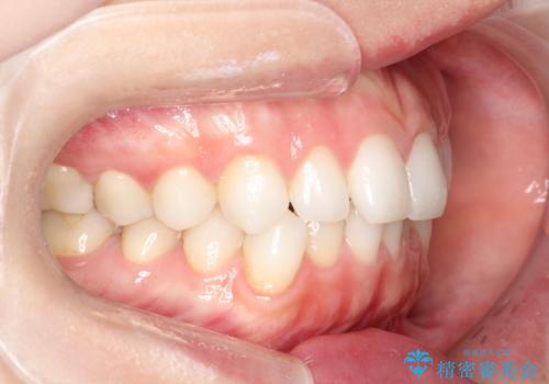 前歯のがたつきをインビザラインで目立たず矯正治療の治療前