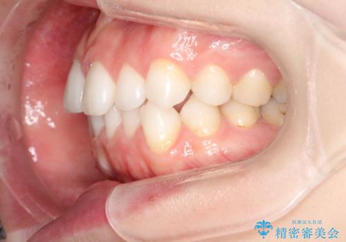 前歯のがたつきをインビザラインで目立たず矯正治療の治療前