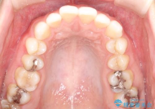 前歯のがたつきをインビザラインで目立たず矯正治療の治療前