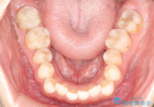 前歯のがたつきをインビザラインで目立たず矯正治療