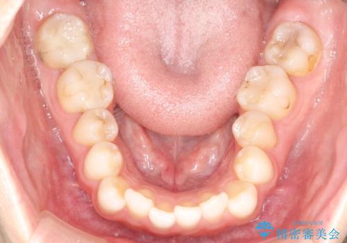 前歯のがたつきをインビザラインで目立たず矯正治療の症例 治療前