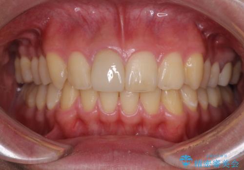 銀歯を白くしたい　セラミックによる審美歯科治療の治療後