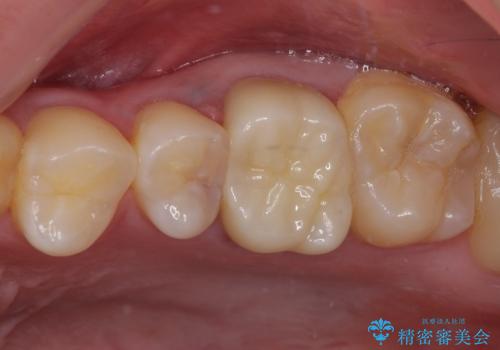 銀歯を白くしたい セラミックによる審美歯科治療の治療後