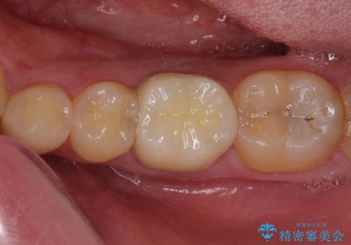 銀歯を白くしたい セラミックによる審美歯科治療の治療後