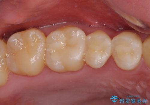 銀歯を白くしたい セラミックによる審美歯科治療の治療後