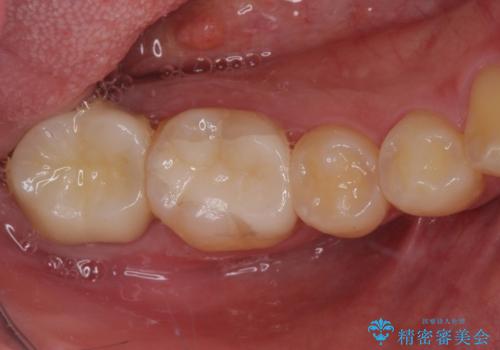 銀歯を白くしたい セラミックによる審美歯科治療の治療後
