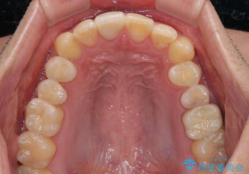 銀歯を白くしたい セラミックによる審美歯科治療の治療後