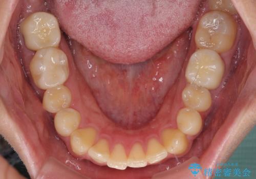 銀歯を白くしたい セラミックによる審美歯科治療の治療後