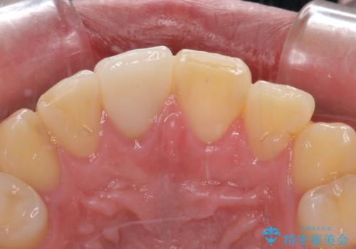 銀歯を白くしたい セラミックによる審美歯科治療の治療後