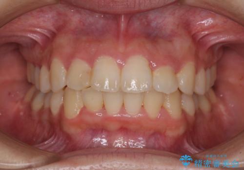 短期間で終了 デコボコをワイヤー矯正で解消の症例 治療後
