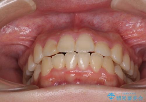 短期間で終了 デコボコをワイヤー矯正で解消の治療後