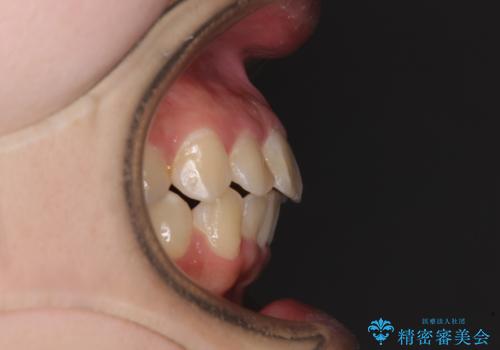 短期間で終了 デコボコをワイヤー矯正で解消の治療後