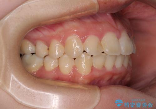 短期間で終了 デコボコをワイヤー矯正で解消の治療後