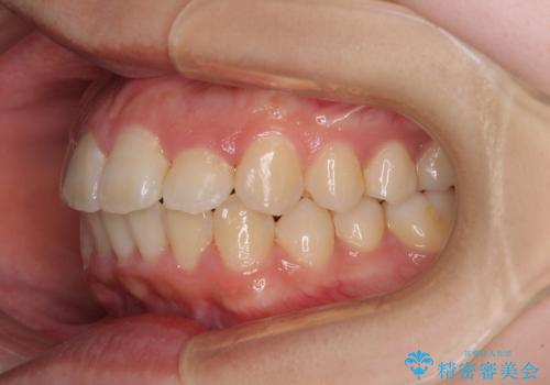 短期間で終了 デコボコをワイヤー矯正で解消の治療後