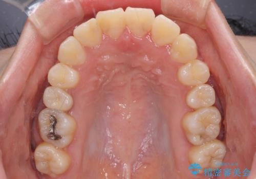 短期間で終了 デコボコをワイヤー矯正で解消の治療後