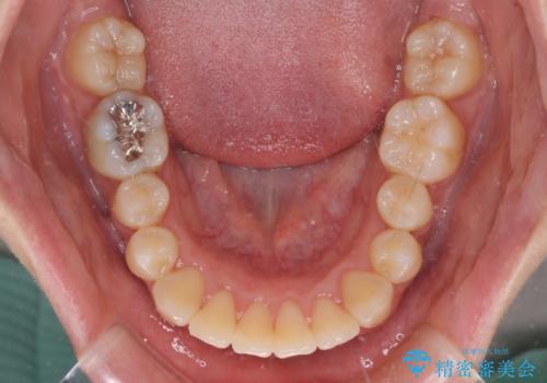 短期間で終了 デコボコをワイヤー矯正で解消の治療後