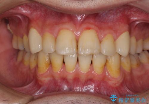 矯正治療後のセラミッククラウンの治療後