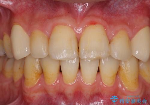 矯正治療後のセラミッククラウンの治療後