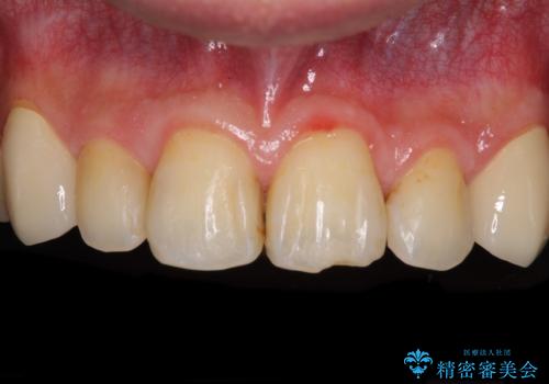 矯正治療後のセラミッククラウンの治療後