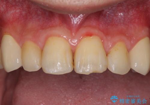 矯正治療後のセラミッククラウンの治療後
