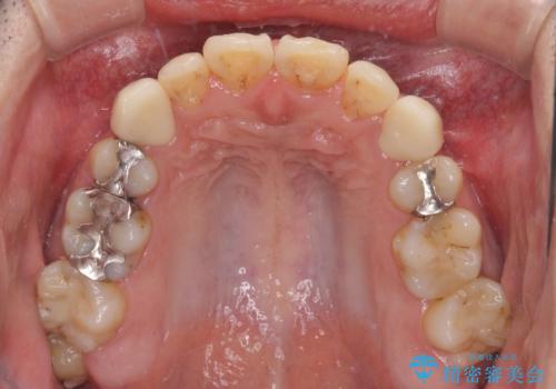 矯正治療後のセラミッククラウンの治療後